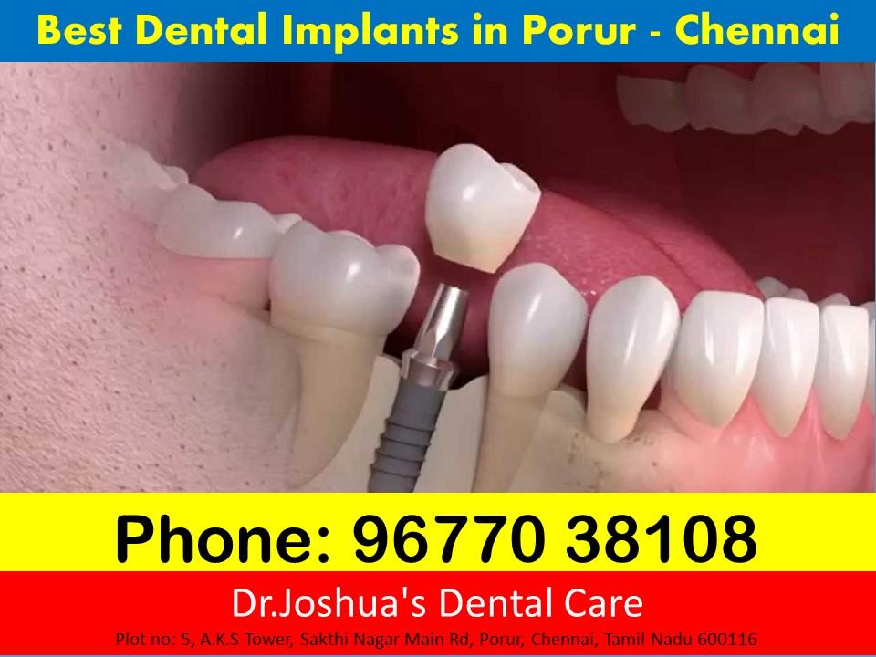 Best Dental Implants in Chennai