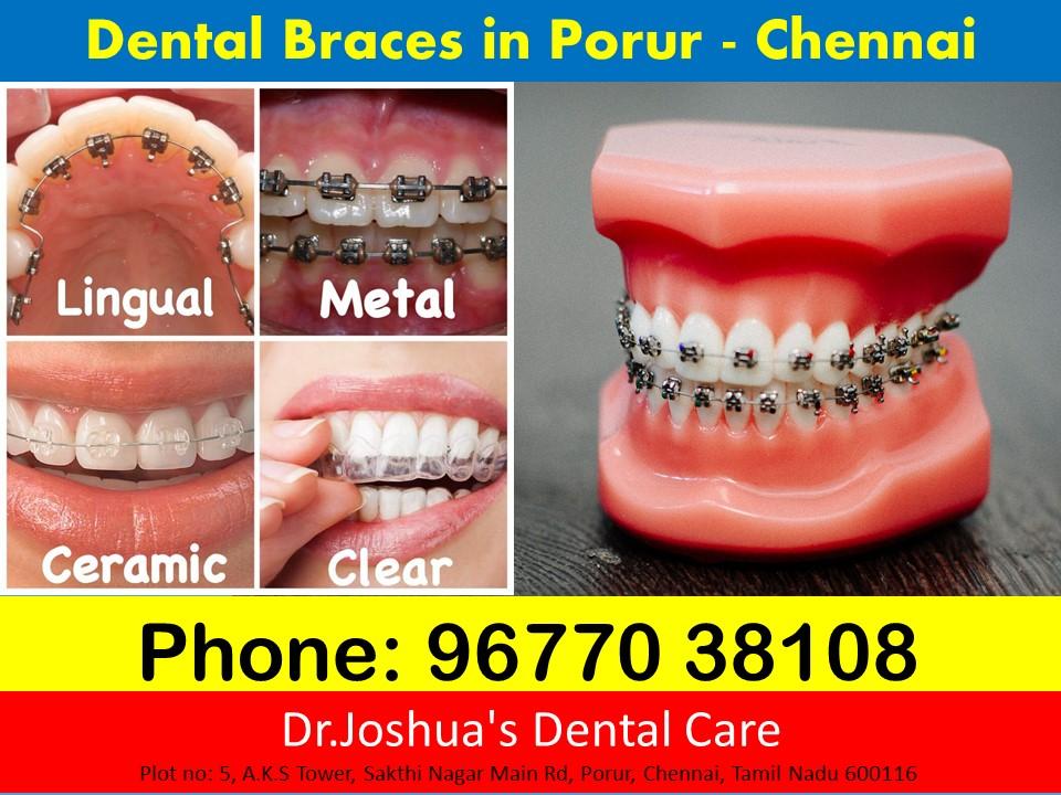 Dental Braces in Chennai