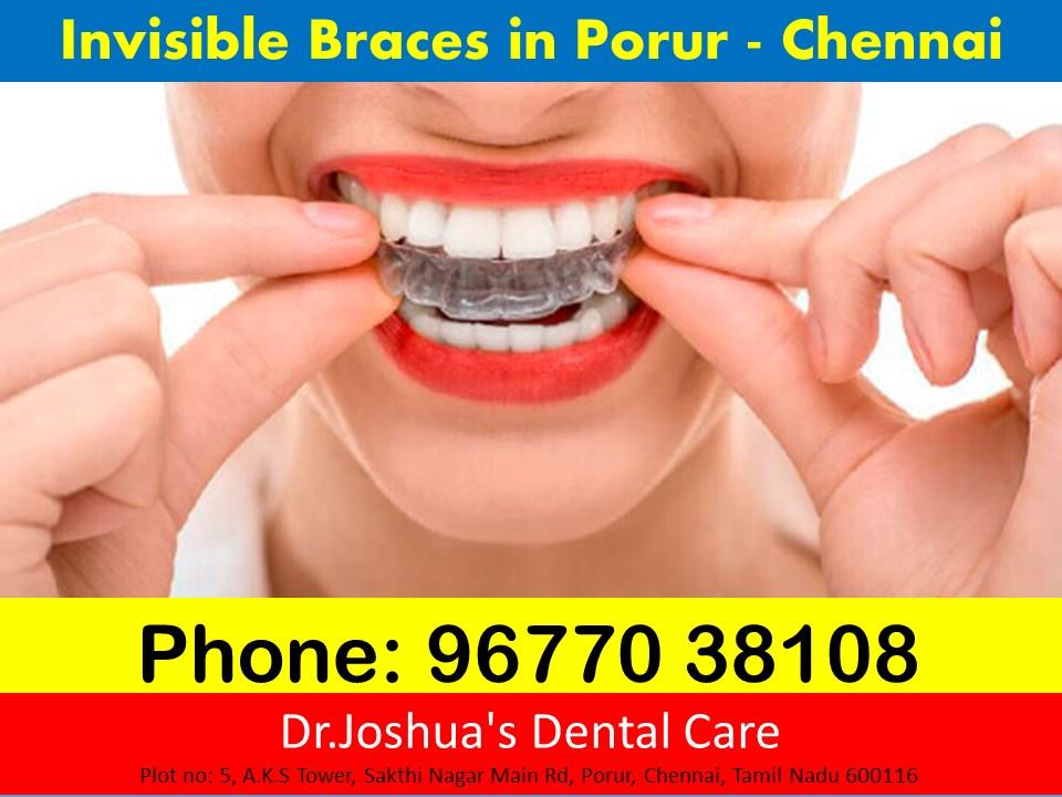 Invisible Braces in Chennai