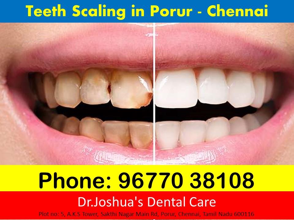 Teeth Scaling in Chennai